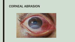 CORNEAL ABRASION
 