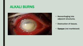 ALKALI BURNS
• Hemorrhaging into
adjacent structures.
• Destruction of tissues.
• Opaque (not marbleized)
 