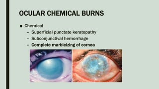 OCULAR CHEMICAL BURNS
■ Chemical
– Superficial punctate keratopathy
– Subconjunctival hemorrhage
– Complete marbleizing of cornea
 