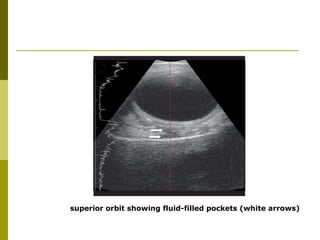 superior orbit showing fluid-filled pockets (white arrows) 
 