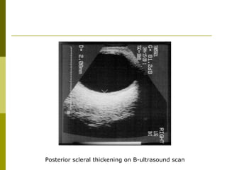Posterior scleral thickening on B-ultrasound scan 
 