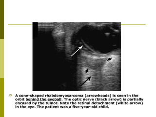  A cone-shaped rhabdomyosarcoma (arrowheads) is seen in the 
orbit behind the eyeball. The optic nerve (black arrow) is partially 
encased by the tumor. Note the retinal detachment (white arrow) 
in the eye. The patient was a five-year-old child. 
 