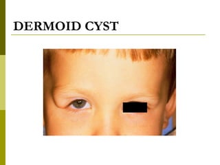DERMOID CYST 
 