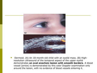  Dermoid. (A) An 18-month-old child with an eyelid mass. (B) High-resolution 
ultrasound of the temporal aspect of the upper eyelid 
demonstrates an oval anechoic lesion with smooth borders. A blood 
vessel (arrow) is demonstrated by this color Doppler examination only 
around the lesion, with no evidence of blood vessels entering it. 
 