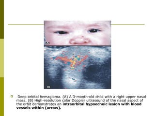  Deep orbital hemagioma. (A) A 3-month-old child with a right upper nasal 
mass. (B) High-resolution color Doppler ultrasound of the nasal aspect of 
the orbit demonstrates an intraorbital hypoechoic lesion with blood 
vessels within (arrow). 
 