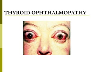 THYROID OPHTHALMOPATHY 
 