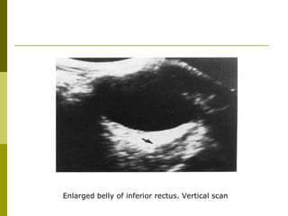 Enlarged belly of inferior rectus. Vertical scan 
 