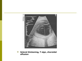  Scleral thickening, T sign, choroidal 
effusion 
 