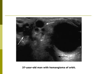 37-year-old man with hemangioma of orbit. 
 