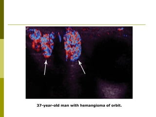37-year-old man with hemangioma of orbit. 
 