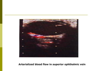 Arterialized blood flow in superior ophthalmic vein 
 