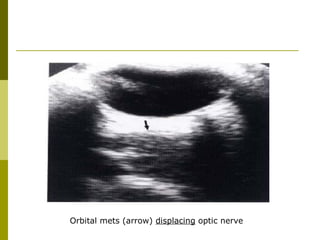 Orbital mets (arrow) displacing optic nerve 
 