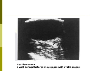 Neurilemomma 
a well-defined heterogenous mass with cystic spaces 
 