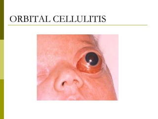 ORBITAL CELLULITIS 
 