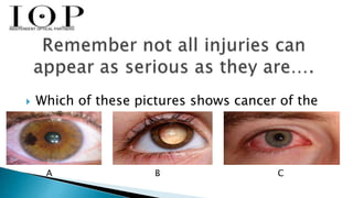  Which of these pictures shows cancer of the 
eye? 
 
A B C 
 