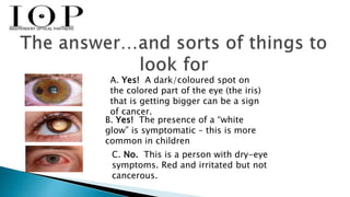 A. Yes! A dark/coloured spot on 
the colored part of the eye (the iris) 
that is getting bigger can be a sign 
of cancer. 
B. Yes! The presence of a “white 
glow” is symptomatic – this is more 
common in children 
C. No. This is a person with dry-eye 
symptoms. Red and irritated but not 
cancerous. 
 