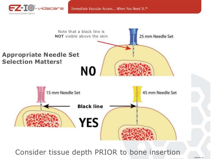 INTRAOSSEOUS NEEDLE INSERTION EPUB INTRAOSSEOUS NEEDLE INSERTION EPUB