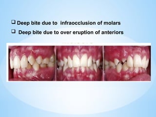  Deep bite due to infraocclusion of molars
 Deep bite due to over eruption of anteriors
 