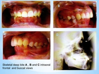 A
C
B
D
Skeletal deep bite A , B and C intraoral
frontal and buccal views
 