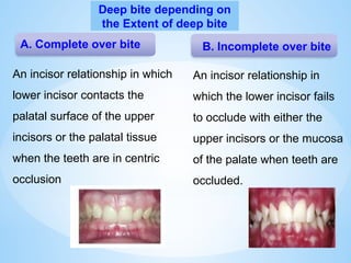 A. Complete over bite B. Incomplete over bite
Deep bite depending on
the Extent of deep bite
An incisor relationship in
which the lower incisor fails
to occlude with either the
upper incisors or the mucosa
of the palate when teeth are
occluded.
An incisor relationship in which
lower incisor contacts the
palatal surface of the upper
incisors or the palatal tissue
when the teeth are in centric
occlusion
 