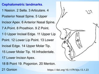 Cephalometric landmarks.
1 Nasion. 2 Sella. 3 Articulare. 4
Posterior Nasal Spine. 5 Upper
Incisor Apex. 6 Anterior Nasal Spine.
7 A Point. 8 Prosthion. 9 Z Point.
1 0 Upper Incisal Edge. 11 Upper Lip
Point. 12 Lower Lip Point. 13 Lower
Incisal Edge. 14 Upper Molar Tip.
15 Lower Molar Tip. 16 lnfradentale.
17 Lower Incisor Apex.
18 B Point 19. Pogonion. 20 Menton.
21 Gonion https://doi.org/10.1179/bjo.13.1.23
 