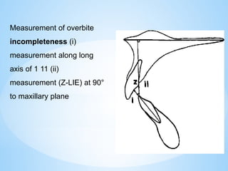 Measurement of overbite
incompleteness (i)
measurement along long
axis of 1 11 (ii)
measurement (Z-LIE) at 90°
to maxillary plane
 