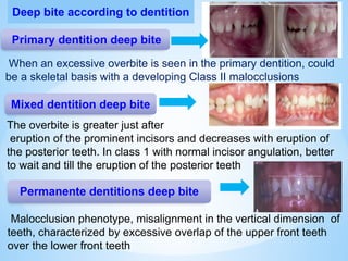 Primary dentition deep bite
Mixed dentition deep bite
Permanente dentitions deep bite
Deep bite according to dentition
When an excessive overbite is seen in the primary dentition, could
be a skeletal basis with a developing Class II malocclusions
The overbite is greater just after
eruption of the prominent incisors and decreases with eruption of
the posterior teeth. In class 1 with normal incisor angulation, better
to wait and till the eruption of the posterior teeth
Malocclusion phenotype, misalignment in the vertical dimension of
teeth, characterized by excessive overlap of the upper front teeth
over the lower front teeth
 