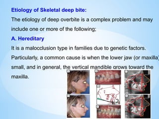 Etiology of Skeletal deep bite:
The etiology of deep overbite is a complex problem and may
include one or more of the following;
A. Hereditary
It is a malocclusion type in families due to genetic factors.
Particularly, a common cause is when the lower jaw (or maxilla)
small, and in general, the vertical mandible grows toward the
maxilla.
 