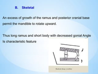 An excess of growth of the ramus and posterior cranial base
permit the mandible to rotate upward.
Thus long ramus and short body with decreased gonial Angle
Is characteristic feature
B. Skeletal
 