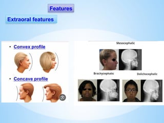 Features
Extraoral features
 