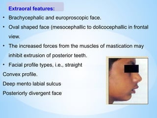 • Brachycephalic and europroscopic face.
• Oval shaped face (mesocephallic to dolicocephallic in frontal
view.
• The increased forces from the muscles of mastication may
inhibit extrusion of posterior teeth.
• Facial profile types, i.e., straight
Convex profile.
Deep mento labial sulcus
Posteriorly divergent face
Extraoral features:
 
