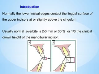Normally the lower incisal edges contact the lingual surface of
the upper incisors at or slightly above the cingulum
Usually normal overbite is 2-3 mm or 30 % or 1/3 the clinical
crown height of the mandibular incisor.
Introduction
 