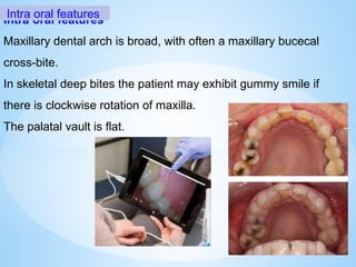 Intra oral features
Maxillary dental arch is broad, with often a maxillary bucecal
cross-bite.
In skeletal deep bites the patient may exhibit gummy smile if
there is clockwise rotation of maxilla.
The palatal vault is flat.
Intra oral features
 