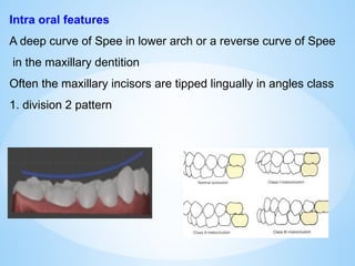 Intra oral features
A deep curve of Spee in lower arch or a reverse curve of Spee
in the maxillary dentition
Often the maxillary incisors are tipped lingually in angles class
1. division 2 pattern
 