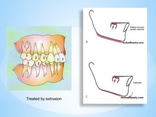 Treated by extrusion
 