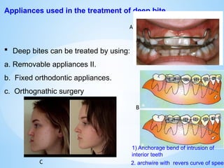 Appliances used in the treatment of deep bite
 Deep bites can be treated by using:
a. Removable appliances II.
b. Fixed orthodontic appliances.
c. Orthognathic surgery
2. archwire with revers curve of spee
1) Anchorage bend of intrusion of
interior teeth
C
B
A
A
 