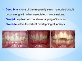 • Deep bite is one of the frequently seen malocclusions, it
occur along with other associated malocclusions.
• Overjet implies horizontal overlapping of incisors
• Overbite refers to vertical overlapping of incisors.
Deep bite
 