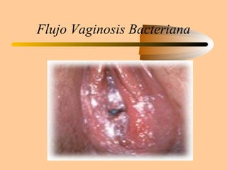 Flujo Vaginosis Bacteriana 