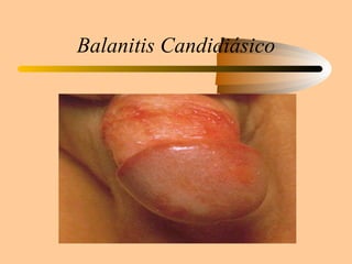 Balanitis Candidiásico 