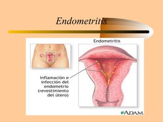 Endometritis 