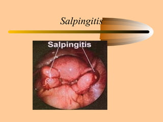 Salpingitis 
