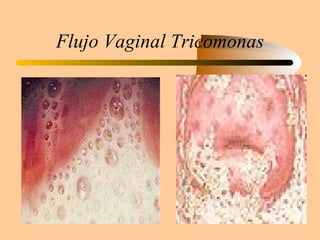 Flujo Vaginal Tricomonas 
