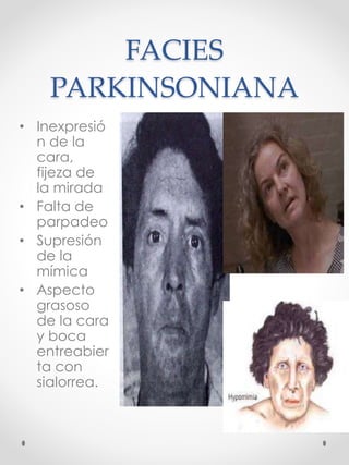 FACIES
PARKINSONIANA
• Inexpresió
n de la
cara,
fijeza de
la mirada
• Falta de
parpadeo
• Supresión
de la
mímica
• Aspecto
grasoso
de la cara
y boca
entreabier
ta con
sialorrea.
 