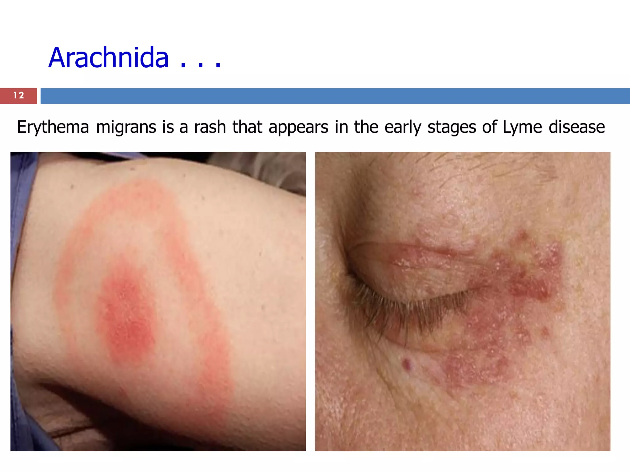 Arachnida . . .
12
Erythema migrans is a rash that appears in the early stages of Lyme disease
 