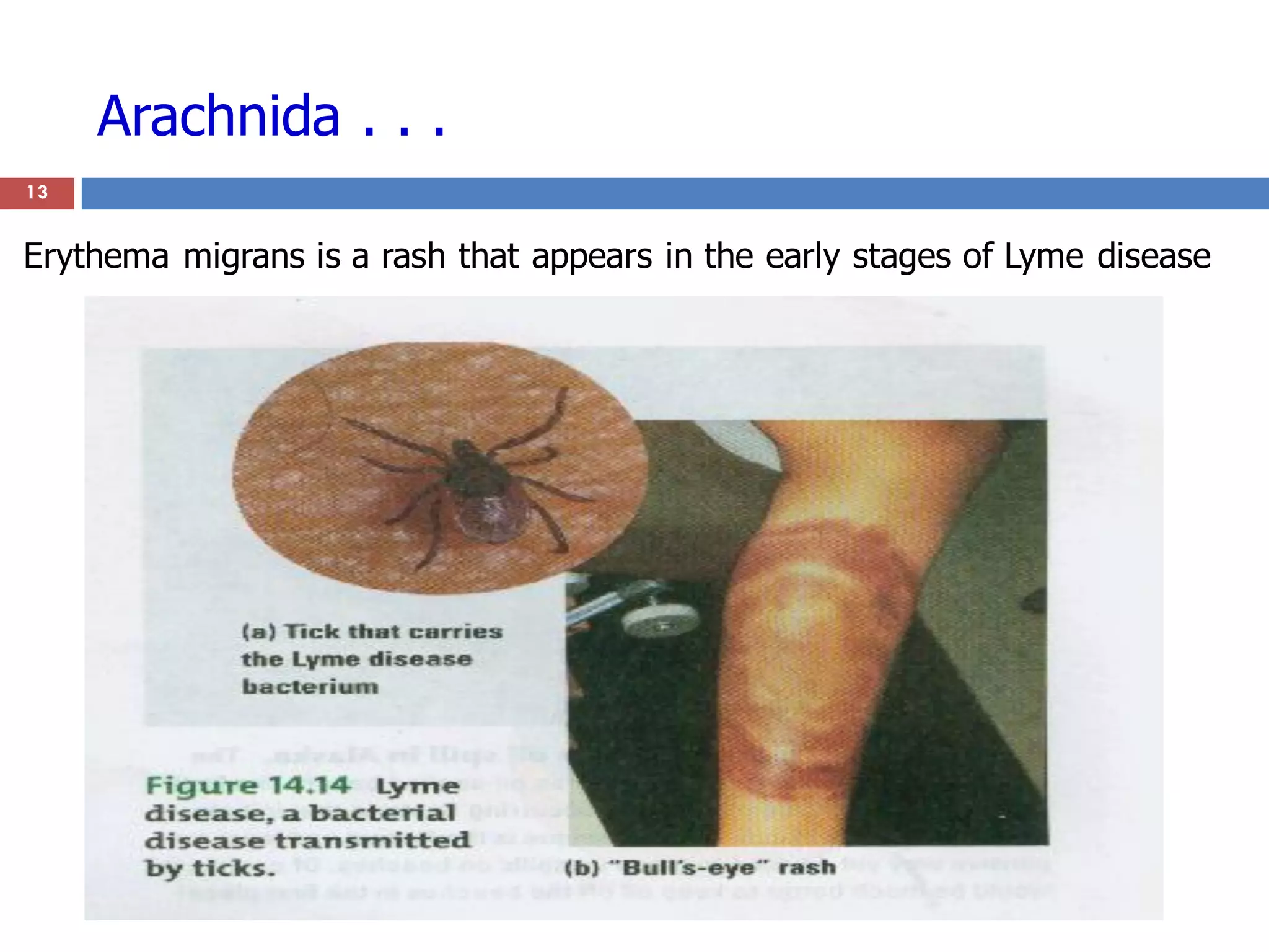 Arachnida . . .
13
Erythema migrans is a rash that appears in the early stages of Lyme disease
 