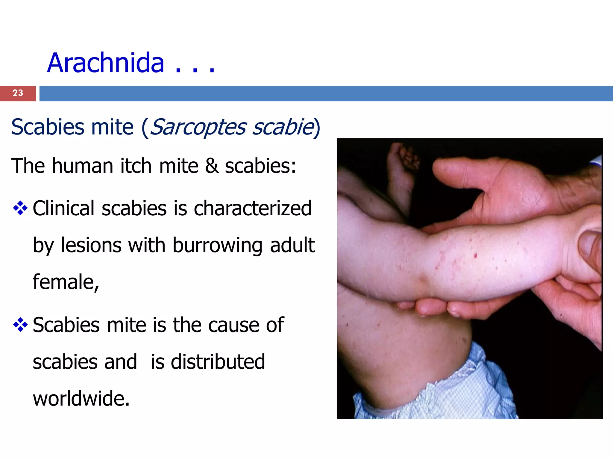 Arachnida . . .
Scabies mite (Sarcoptes scabie)
The human itch mite & scabies:
 Clinical scabies is characterized
by lesions with burrowing adult
female,
 Scabies mite is the cause of
scabies and is distributed
worldwide.
23
 