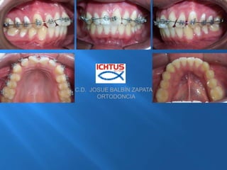 C.D.  JOSUE BALBÍN ZAPATA              ORTODONCIA