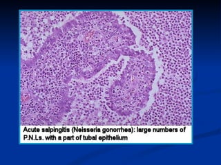 II. GERM CELL TUMORS:
1- Teratoma
2- Dysgerminoma (seminoma ovarii)
3- Yolk sac tumor= Endodermal sinus tumor
4- Embryonal...