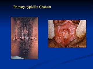 Lymphgranuloma venereum:
STD, Chlamydia trachomatis, tropical areas, vesicles that
rupture and form punched out painless u...