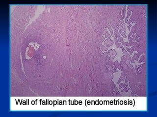 2- TUMORS OF FALLOPIAN TUBE-
-   Rare. Most common is adenocarcinoma (like
    serous adenocarcinoma of the ovary).
-   Re...